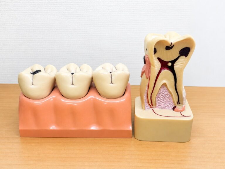 むし歯の進行を示す模型